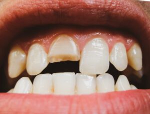 fillings